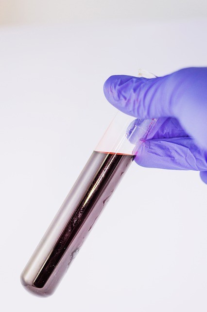 The litigants claim that Theranos CEO Elizabeth Holmes lied about the technology used for carrying out blood tests. (Pixabay)