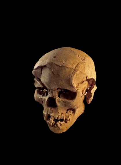 Skull with multiple lesions on front and left side, consistent with wounds from a blunt implement.
