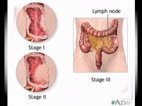  Researchers have found that although a person can live without an appendix, having it bolsters the body's immune capabilities. (YouTube)