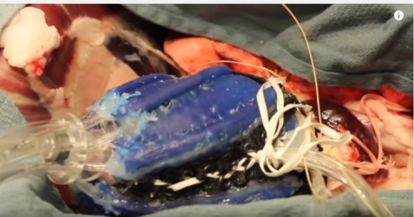 An emerging study shows that this soft robotic sleeve could help failing hearts pump blood.