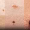 Some types of skin cancer might look like a simple mole or a skin rash until further tests reveal otherwise