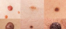 Some types of skin cancer might look like a simple mole or a skin rash until further tests reveal otherwise