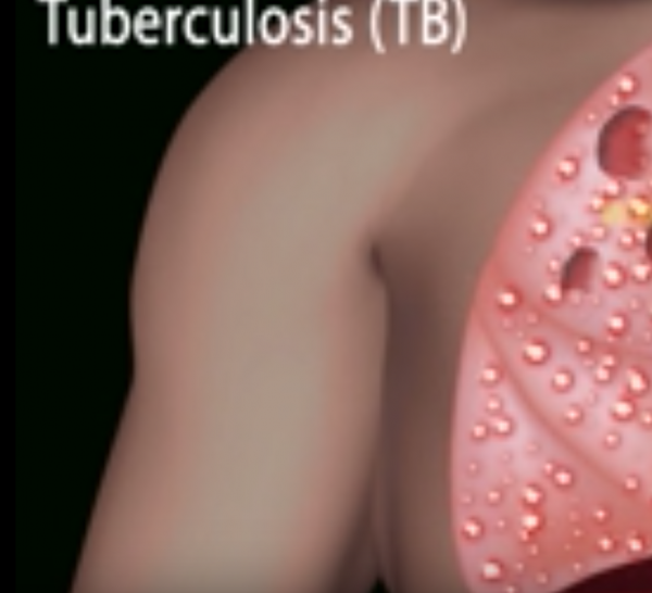  TB, which is communicable through air, is one of the top 10 causes of deaths worldwide. (YouTube)