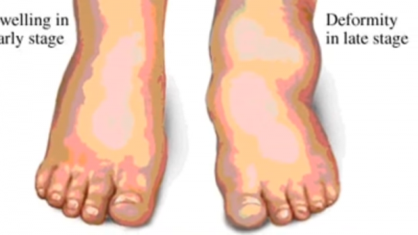 The Charcot Foot is a condition in which the bones of the foot starting to get weak, it affects people experiencing nerve damage or also called neuropathy. 