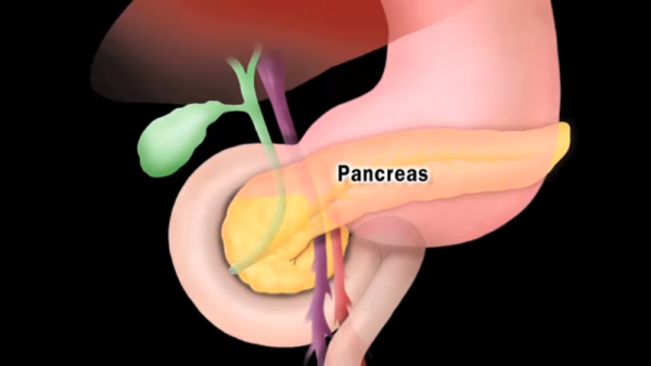 One of the major reasons why pancreatic cancer cannot be diagnosed earlier because it does not produce any signs and symptoms. 