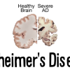 The first sign of Alzheimer's disease is thought to be cognitive impairment. But in new findings, the first sign of the illness is decline glucose level in the brain.