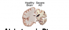 The first sign of Alzheimer's disease is thought to be cognitive impairment. But in new findings, the first sign of the illness is decline glucose level in the brain.