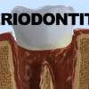 A severe gum infection is called periodontitis. It often damages the soft tissues and the structures that hold the teeth.