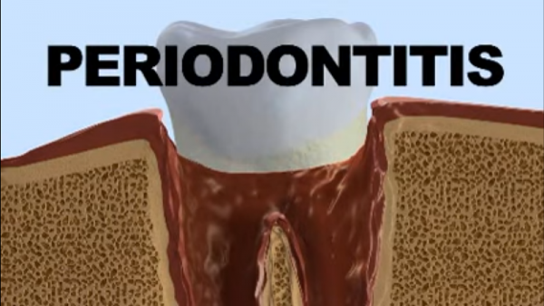 A severe gum infection is called periodontitis. It often damages the soft tissues and the structures that hold the teeth.