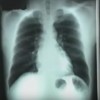 A X-ray scan can be used to detect the presence of TB in a patient. (YouTube)