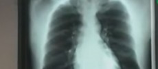 A X-ray scan can be used to detect the presence of TB in a patient. (YouTube)