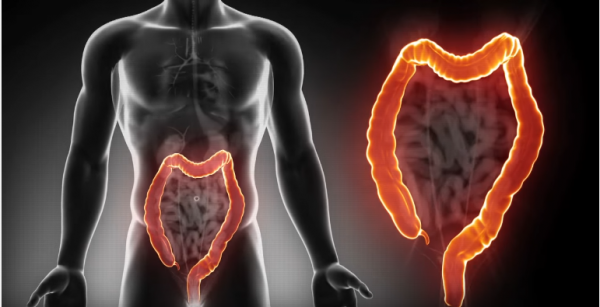 Aussie scientists have made a breakthrough in preventing growth of colon and stomach cancer. (YouTube)