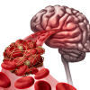 A stroke occurs when a blood vessel that provides the nutrients and oxygen towards the brain is blocked or ruptured.