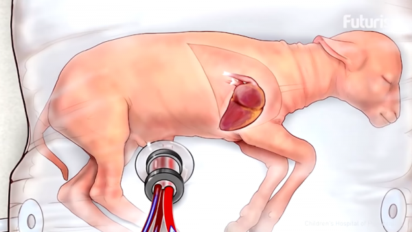 The artificial womb is a bridge between the outside world and the womb of the mother to carry the infant from 23 to 28 weeks of gestational age. (YouTube)