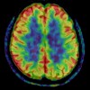 PET Scan of CTE 