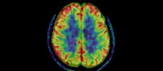 PET Scan of CTE 