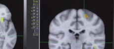 A brain scan result is displayed on a monitor. 