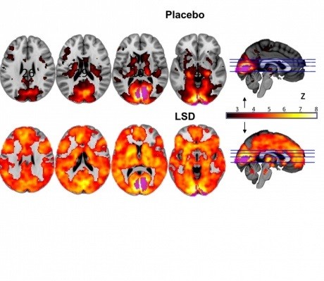 This image shows how, with eyes-closed, much more of the brain contributes to the visual experience under LSD than under placebo. The magnitude of this effect correlated with participants reports of complex, dreamlike visions.