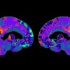 PET Scan of 'Chemo Brain' (R)