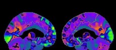 PET Scan of 'Chemo Brain' (R)