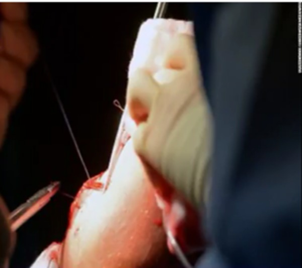 Swiss surgeons have been able to use cells from the nose of patients to improve their damaged knees.